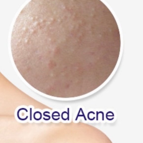 Anti acne whitening soap - Picture 7 of 7